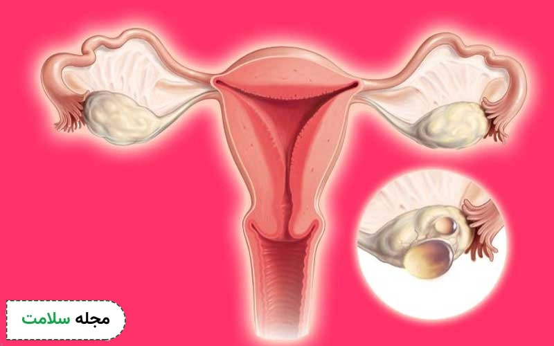 فرق تنبلی تخمدان خفیف و شدید چیست؟ تفاوت علائم و نوع درمان آنها