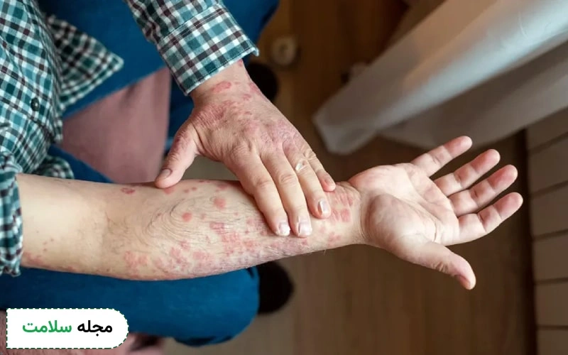 عکس روماتیسم پوستی به این شکل نمایان می شود. 