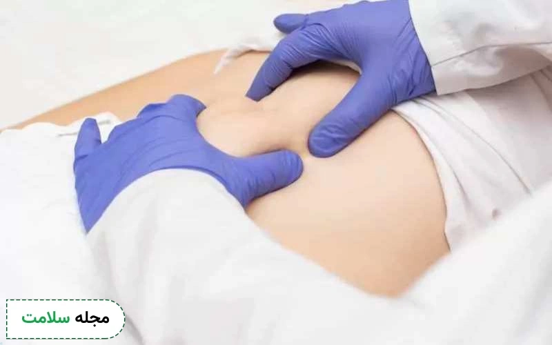 علائم فتق شکم چیست؟