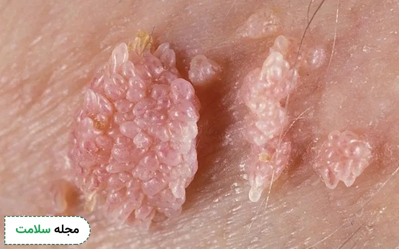 شکل زگیل تناسلی؛ زگیل تناسلی چه شکلی است؟