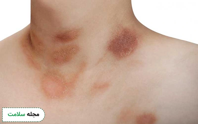 جوش پولکی روزه آ چه نوع ضایعاتی روی پوست ایجاد میکند؟ راه درمان آن چیست؟