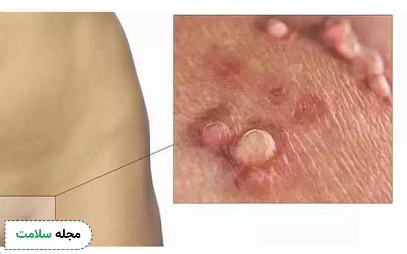 راه های پیشگیری از زگیل تناسلی در زنان و مردان چیست؟