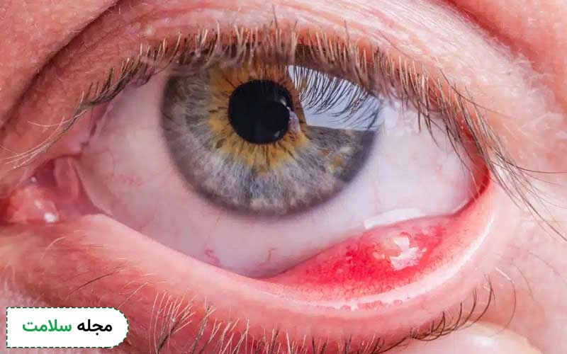 عفونت چشم نشانه چیست و چه درمانی دارد؟