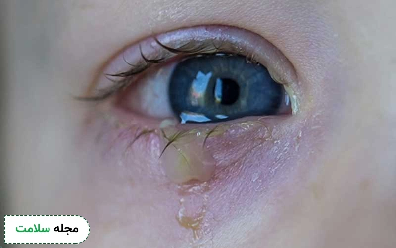 عکس عفونت چشم کودکان