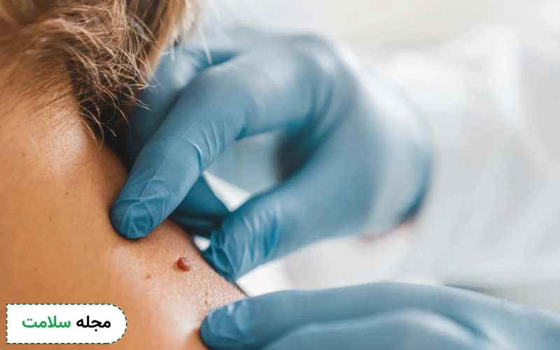 خال گوشتی چه تفاوتی با سایر خال ها دارد؟ چگونه این خال ها را برداریم؟