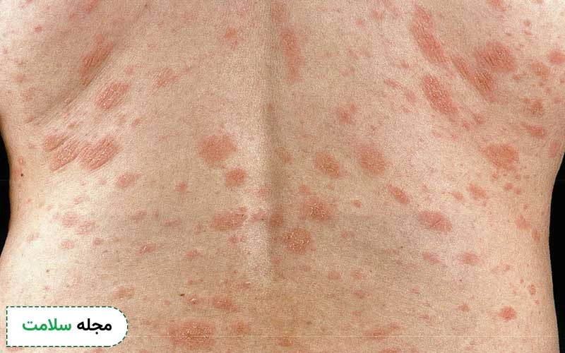 تصویر بیماری پیتریازیس روزه آ چگونه است؟