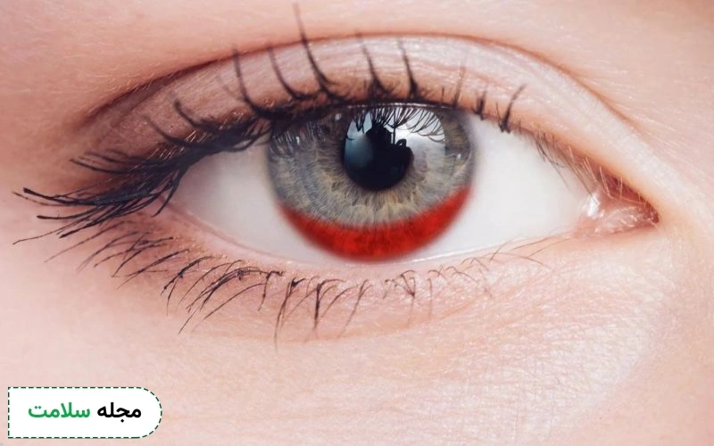 خونریزی چشم چه علائمی دارد؟