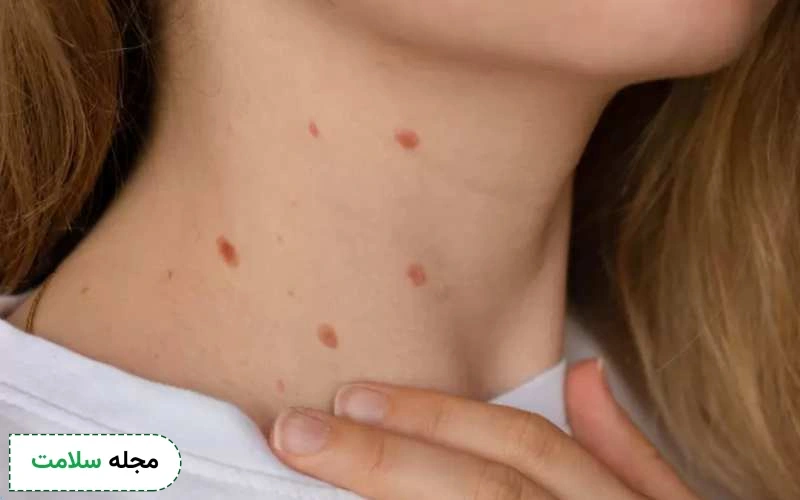 خال های سرطانی چند نوع است؟