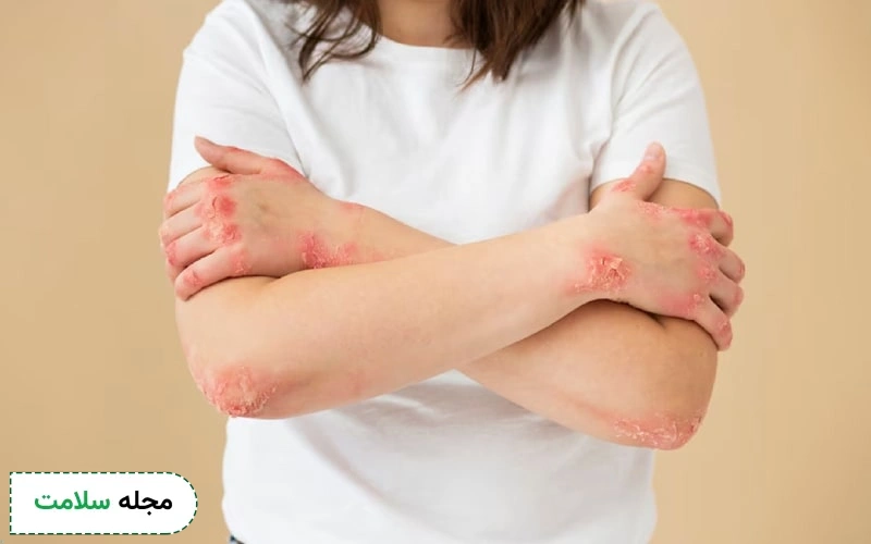 روماتیسم لوپوس چیست و چه تاثیری روی هر عضو بدن دارد؟