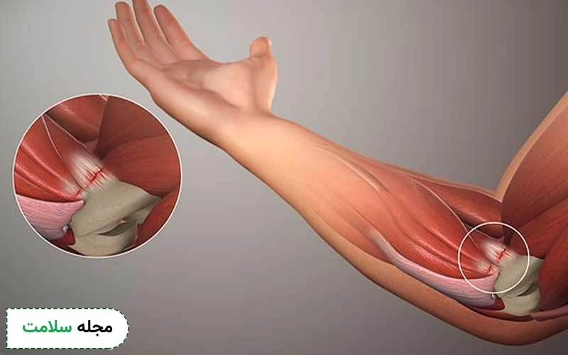 آیا ورم جزو علائم تاندونیت است؟
