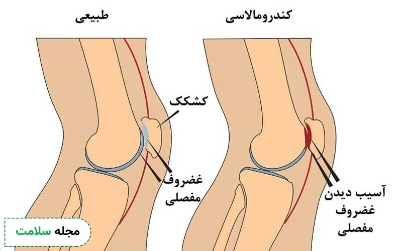 تصویر نرمی کشکک زانو نشان دهنده چه چیزی است؟