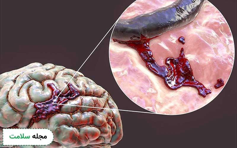 مزیت عمل خونریزی مغزی چیست؟