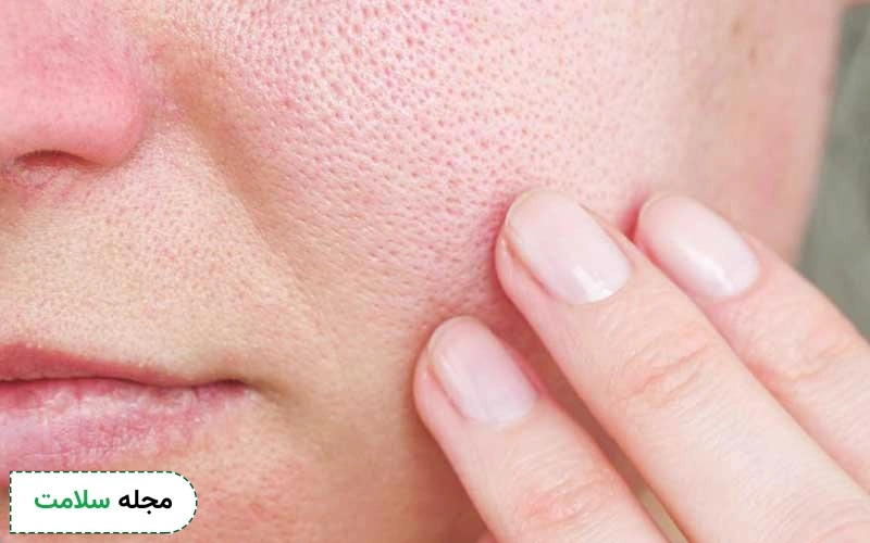 علت ایجاد منافذ باز پوست چیست؟ معرفی 18 روش درمان این منافذ