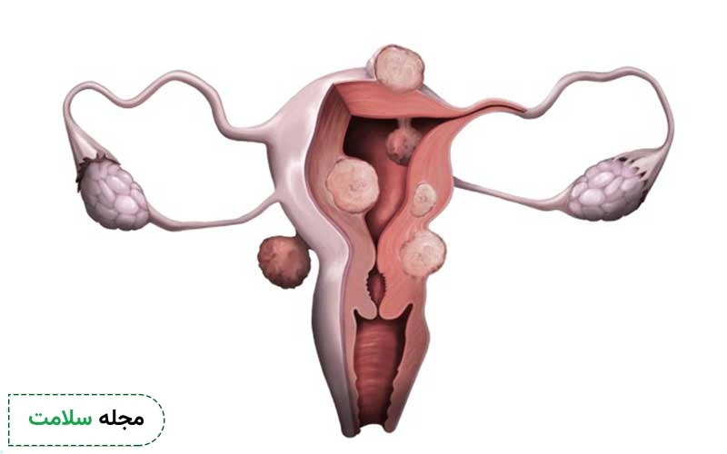 احساس خستگی یکی از عوارض فیبروم رحم است؟