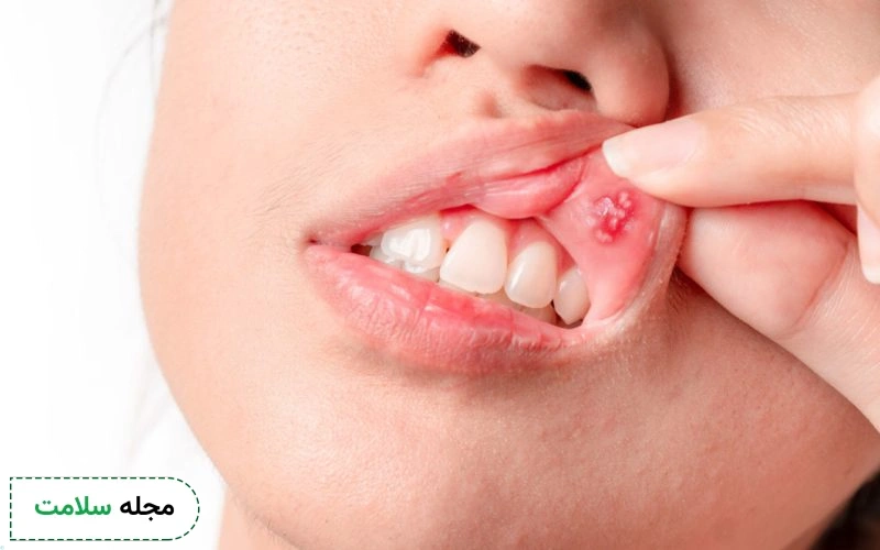لیکن پلان چه نوع بیماری است؟ راه های تشخیص و درمان آن چیست؟
