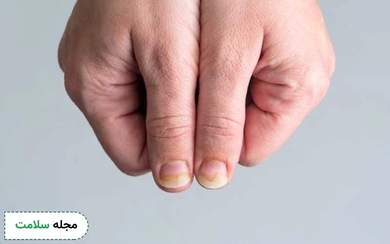 قارچ ناخن چیست؟ این بیماری چه علائمی داشته و چگونه درمان میشود؟