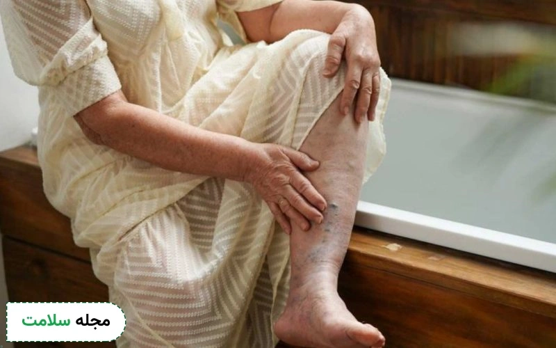 بیماری فلبیت چیست؟ چه علائمی دارد و چگونه درمان میشود؟