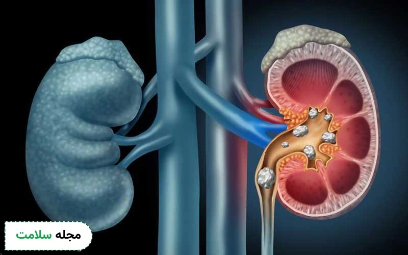 عمل سنگ کلیه مناسب چه بیمارانی است؟ دوره نقاهت آن چگونه است؟