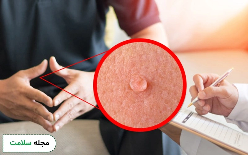 زگیل تناسلی کم خطر عوارض کمتری دارد.