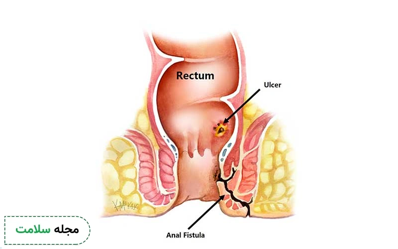 فیستول چه شکلی است؟