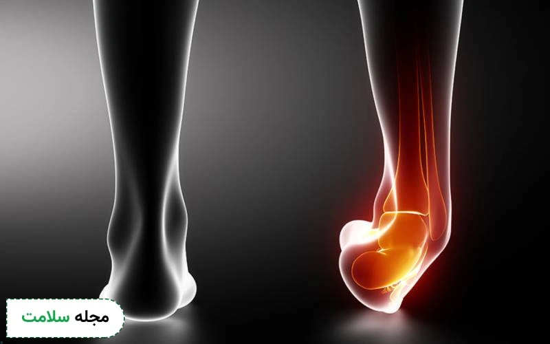 عکس کشیدگی رباط به این شکل است.