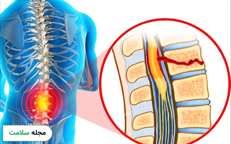 آسیب نخاعی کمری به دو نوع تقسیم میشود.