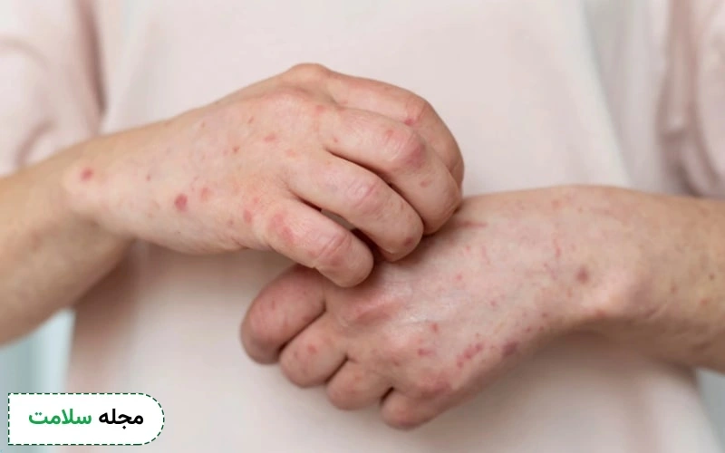 درماتیت تماسی چیست؟ چه علائم و علتی دارد و چگونه از شر آن خلاص شویم؟