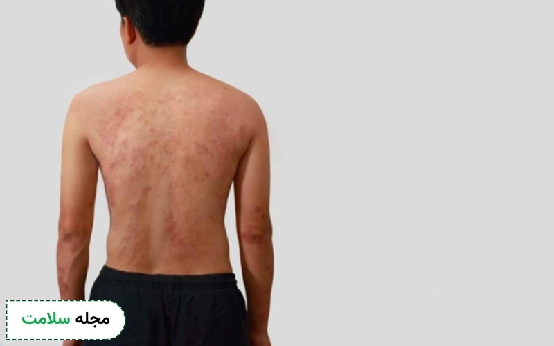 درماتیت هرپتی فرم چیست؟ علائم، علل و راه های درمان آن