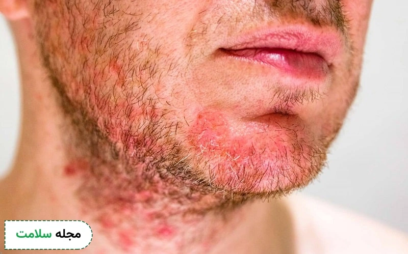 پیشگیری از درماتیت صورت با رعایت نکات بهداشتی ممکن است.