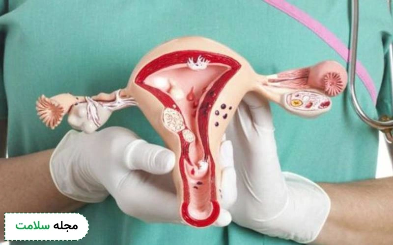 آیا اندومتریوز درمان دارد؟