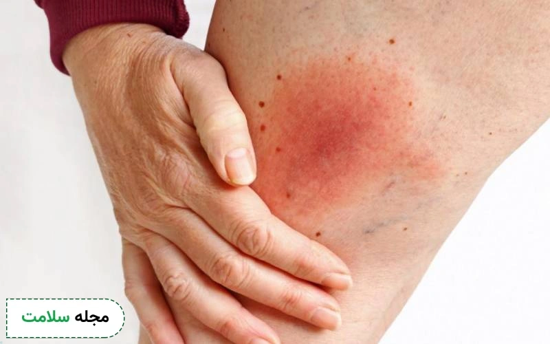 بیماری واسکولیت باعث آسیب به رگ ها می شود.