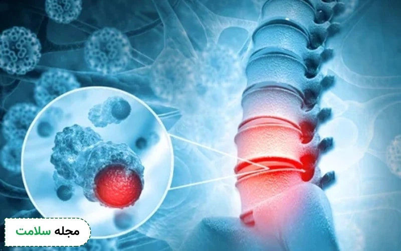 متاستاز استخوان می تواند مربوط به انواع مختلف سرطان باشد.