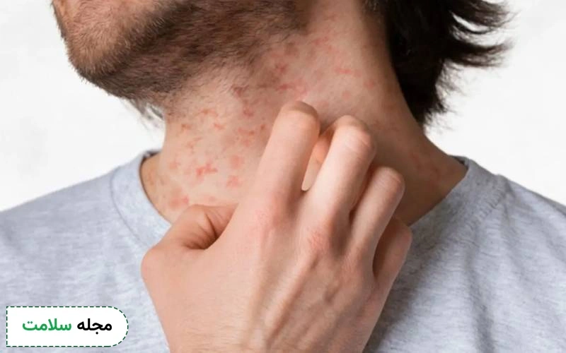 واسکولیت (رگ آماس) چیست؟ علائم، علل و راه های درمان التهاب رگ