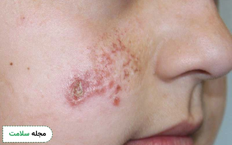 تصویری از سالک تازه روی صورت کودک