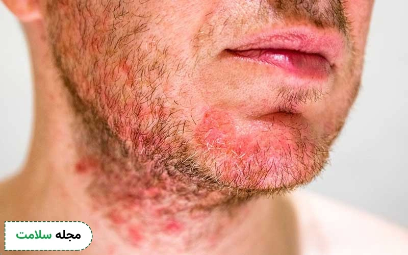 برای تشخیص درماتیت سبوره باید علائم آن بررسی شود.