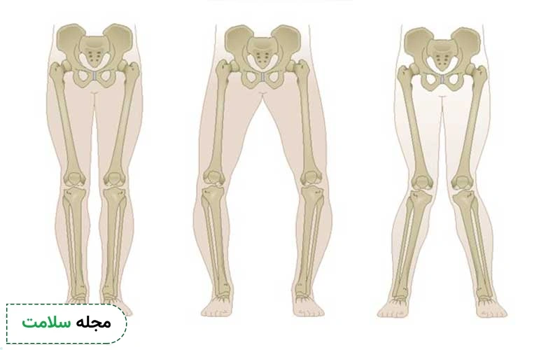 علائم پاهای پرانتزی را چگونه تشخیص دهیم؟ آیا راه درمان سریع دارد؟