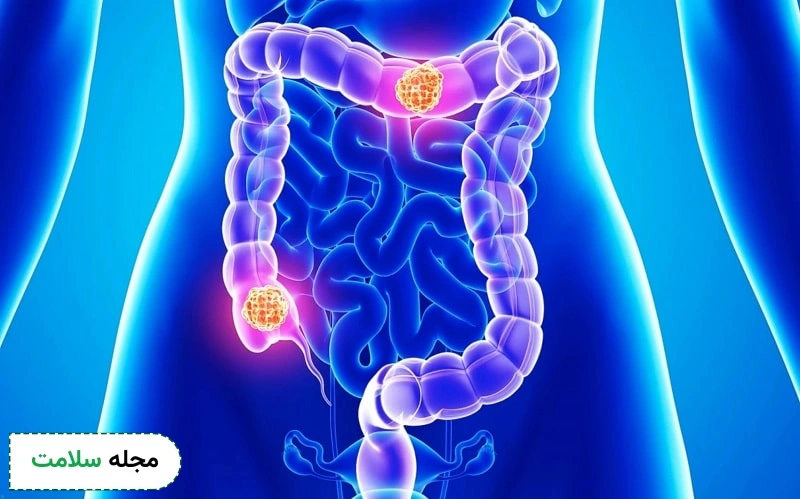 متاستاز روده کوچک آخرین مرحله این سرطان است.
