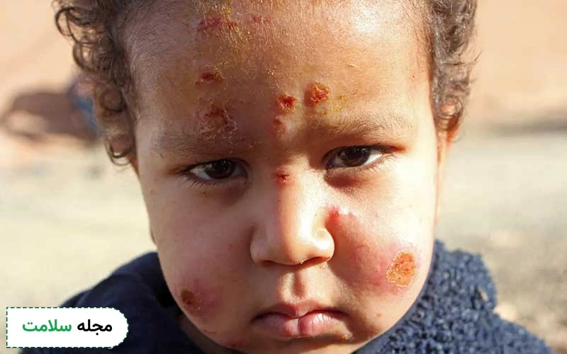 معرفی 14 روش درمان سالک | درمان قطعی لیشمانیوز چیست؟