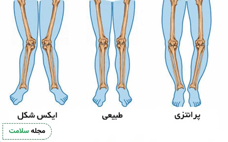 تصویر انواع مشکلات پای پرانتزی و ایکس شکل را مشاهده می کنید.