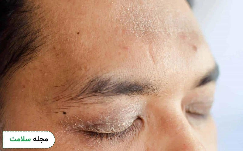 درماتیت تماسی پلک 