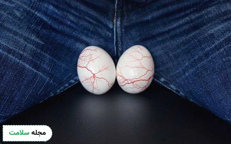 واریکوسل گرید 3 چیست و چگونه آن را درمان کنیم؟