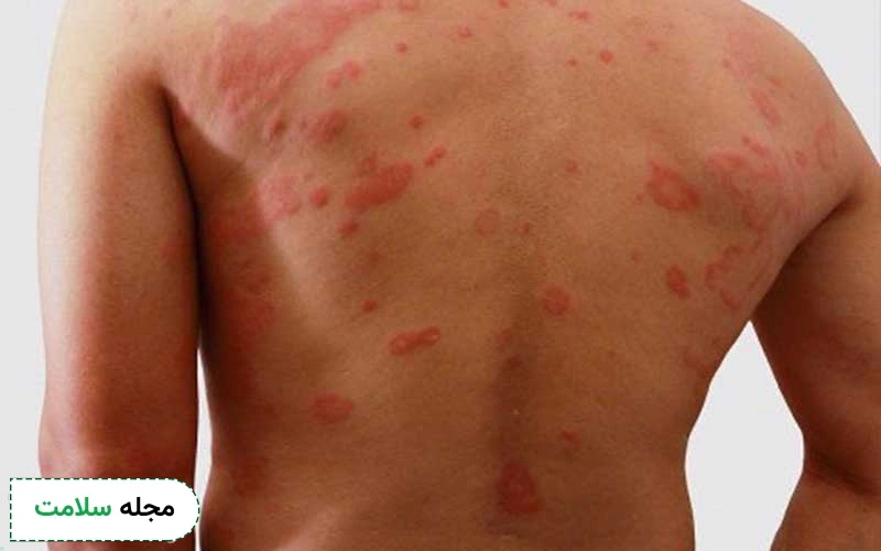 درماتیت سبوره (درماتیت سبورئیک) چیست؟ علائم و راه درمان آن