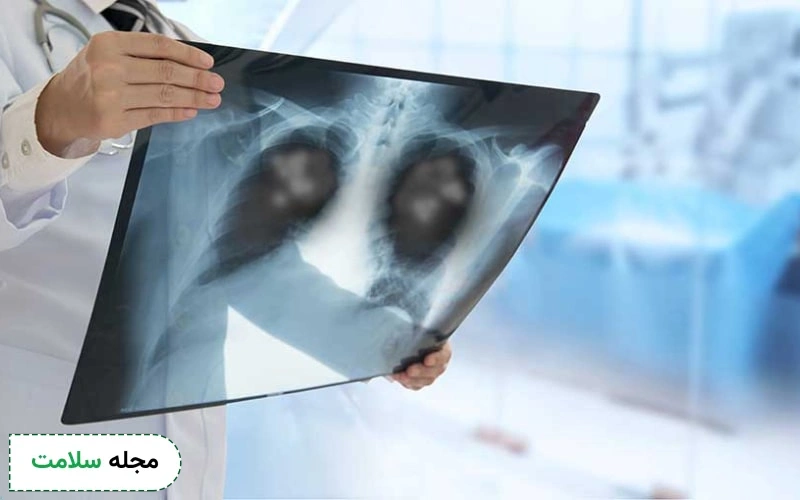 متاستاز ریه چیست و چگونه درمان میشود؟