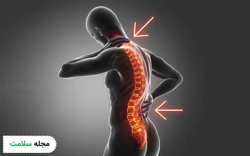 گودی کمر (لوردوز) چیست؟ علت، عوارض و راه درمان آن