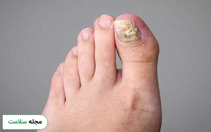 علت قارچ ناخن کاشت چیست؟ چه علائمی دارد و چطور درمان میشود؟