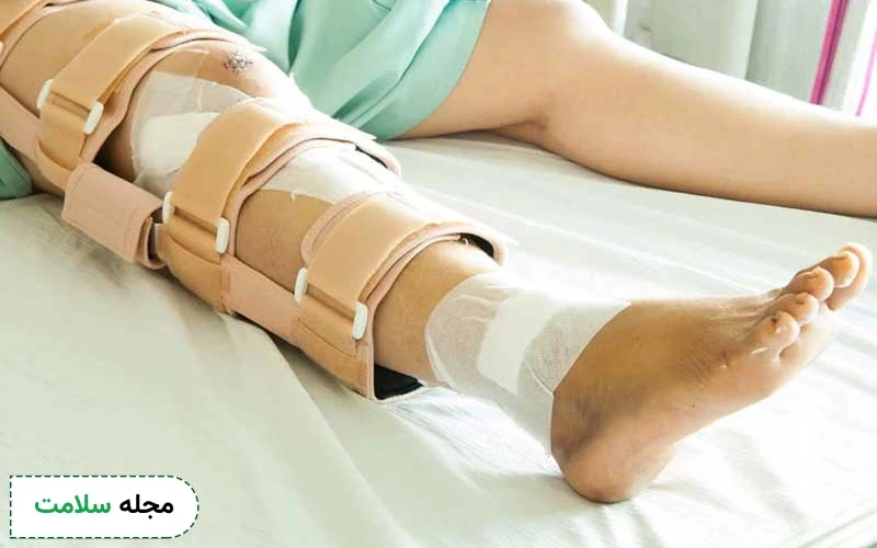 شکستگی زانو چگونه است؟ علائم، راه های تشخیص و درمان شکستگی کشکک زانو