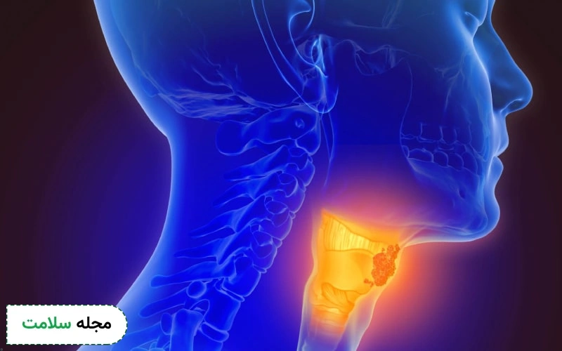 پیشگیری از hpv یکی از راههای پیشگیری از سرطان حلق است.