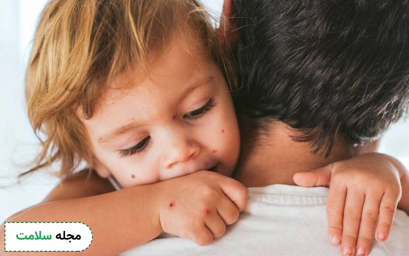 انتقال آبله مرغان تا چند روز است؟