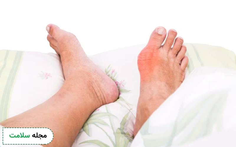 چه غذایی برای نقرس خوبه؟