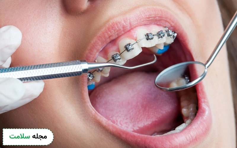 علت تحلیل لثه در ارتودنسی چیست؟ آیا می توان آن را درمان کرد؟